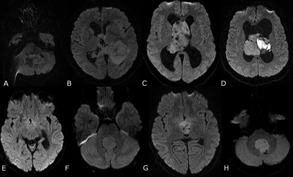 Fig. 10: Intraventricular brain tumors - comparative overview of DWI images (b=1000) A.