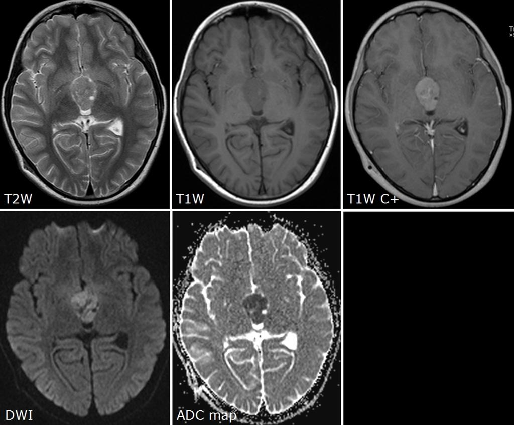 Images for this section: Fig. 1: Medulloblastoma WHO grade IV in the third ventricle.