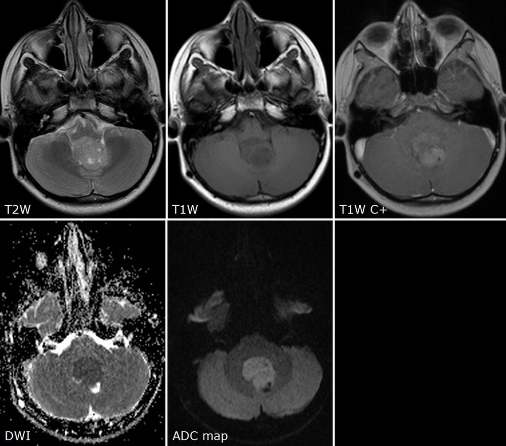Fig. 2: Medulloblastoma WHO grade IV in the fourth ventricle.
