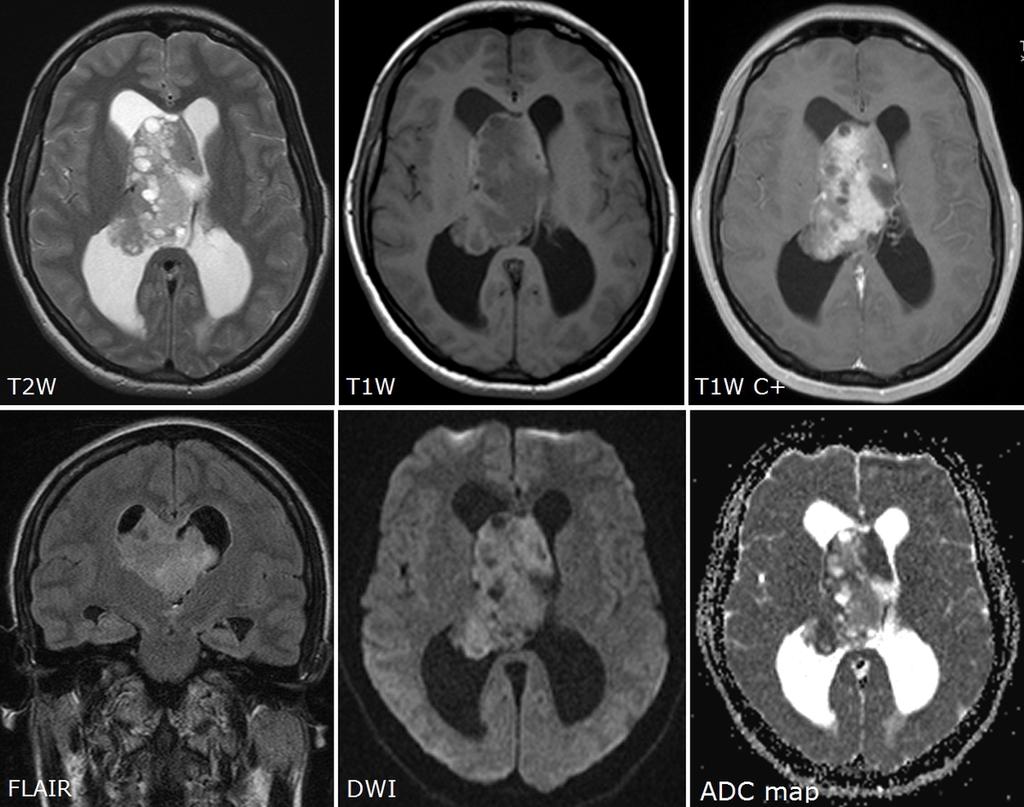Fig. 3: Central neurocytoma WHO grade II in the third and lateral ventricles in a 23-yearold female with a history of frontal headache.