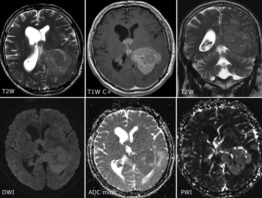 Fig. 4: Intraventricular low-grade B-cell lymphoma in the left trigone. Disease manifested by right-sided mild hemiparesis and headache.