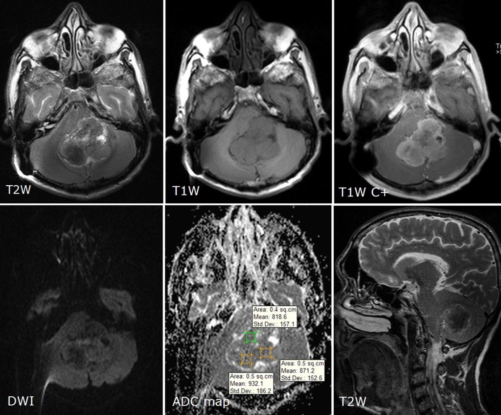 Fig. 5: Intraventricular fibroplastic meningioma grade I in the fourth ventricle in patient with internal hydrocephalus.