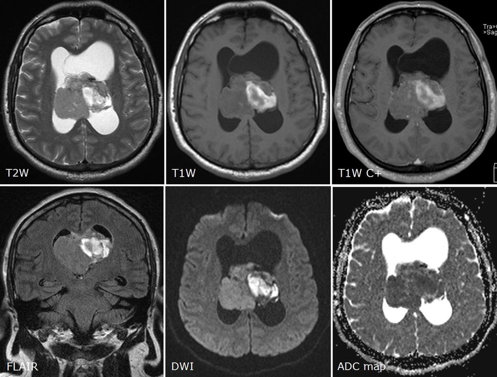 Fig. 6: Intraventricular ependymoma grade II in the lateral ventricles. Disease manifested by severe headaches, diplopia and incoordination.