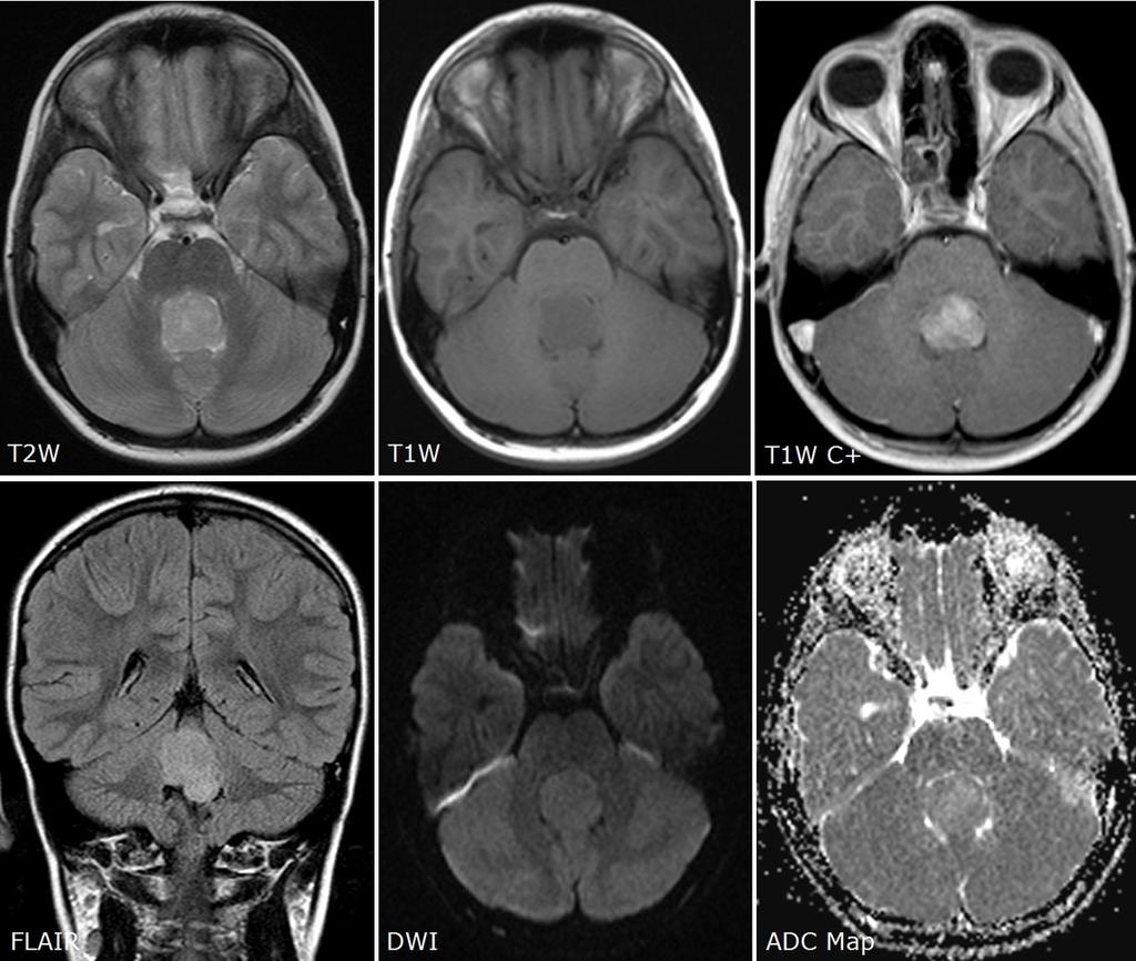 Fig. 7: Intraventricular ependymoma grade II in the fourth ventricle. Axial T2W and coronal FLAIR images show hyperintense mass in the ventricle without adjacent edema.