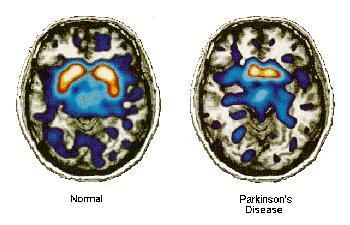 WHAT IS PARKINSON S DISEASE?