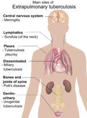Extrapulmonary TB Disease Sites Lymphadenitis Central nervous system Miliary Pleural Bone and joint