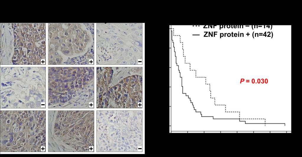 SUPPLEMENTARY FIGURES Figure S1. Clinical significance of ZNF322A overexpression in Caucasian lung cancer patients.