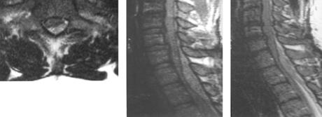injury Spinal cord