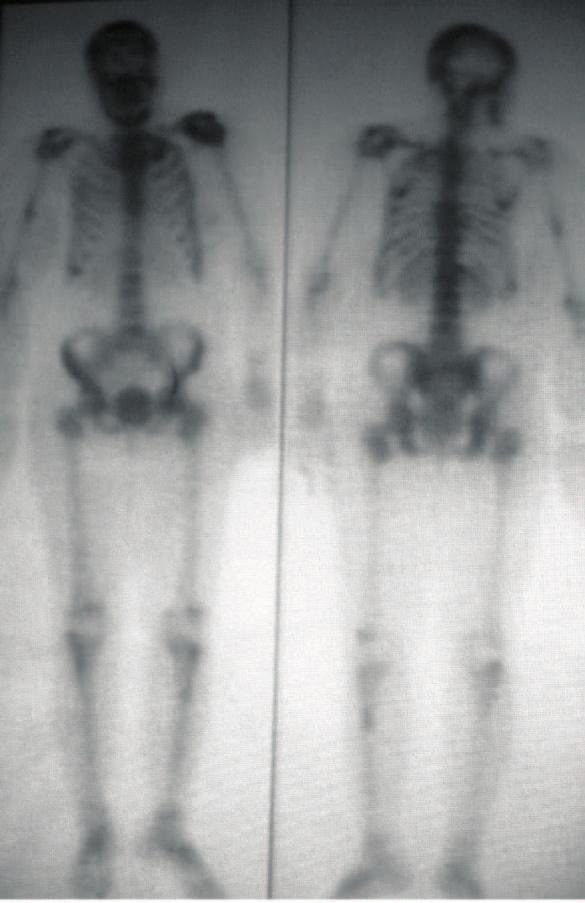 Sepideh Sefidbakht et al. noted. A plain X-ray of the pelvis revealed findings similar to those seen previously in her feet and knees (Figure 5).