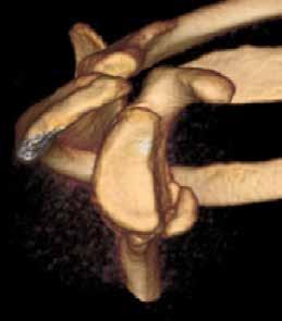 instability can be challenging in the presence of structural bone defects of the glenoid or humerus.
