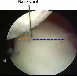 Therefore, it is important to recognise the presence of any bone defects prior to surgery in patients with instability.