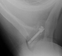 5% RECURRENCE RATE, THE ARTHROSCOPIC PROCEDURE WAS SIGNIFICANTLY MORE EXPENSIVE AS A RESULT OF THE LONGER OPERATION TIME AND THE USE OF ADDITIONAL EQUIPMENT.