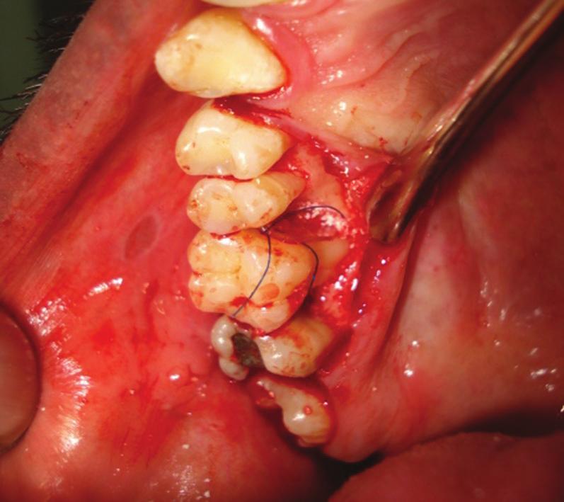 Figure 4: Bone graft Figure 5: Guided tissue regeneration membrane placed over bone graft Figure 6: Post-operative region of the jaw since 2 months.