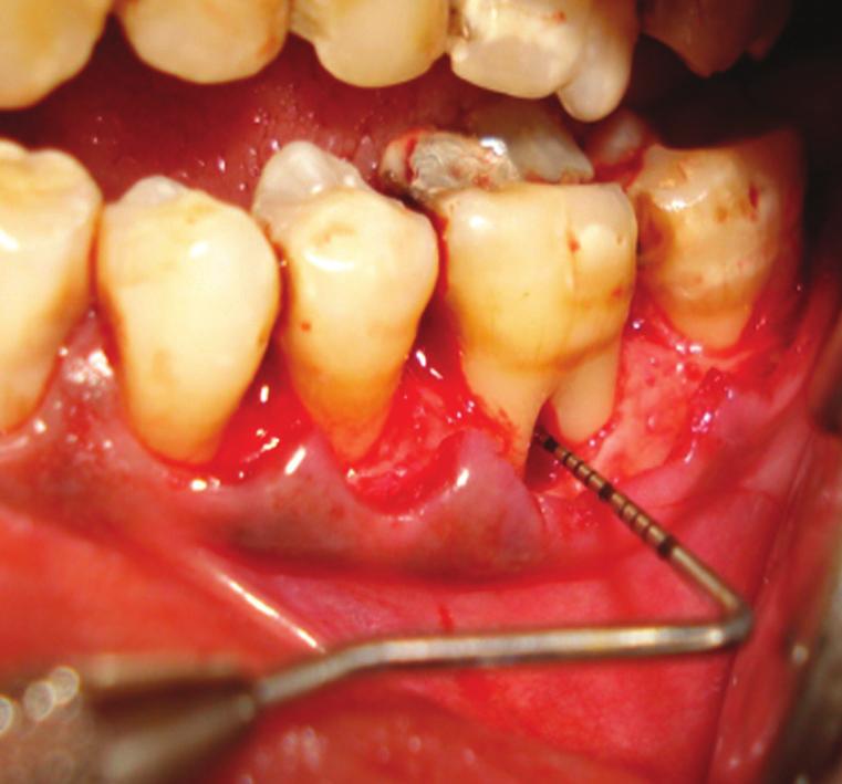 Figure 8: Pre-operative intra-oral periapical radiograph