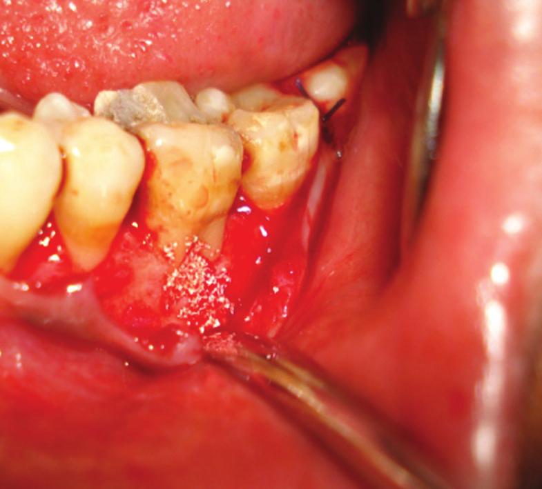 Post-operative Figure 13: Post-operative intra-oral