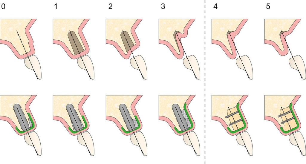 Benic & H ammerle Fig. 3. Schema displaying bone defect Classes 0 5 and the corresponding bone augmentation procedures. Table 3.