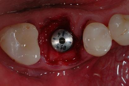 The distance between the implant surface and the bone walls exceeds 2