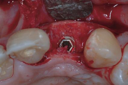 Intra-oral sites for the harvesting of bone blocks encompass the chin and the retromolar mandibular region, including the mandibular ramus.