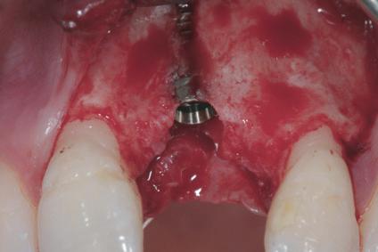 glycol membrane. (F) Re-entry surgery 6 months after implant placement. (115, 215).