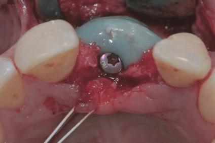 However, morbidity and complications related to the donor site, limited graft availability and unpredictable graft resorption are major limitations related to the use of autogenous grafts (41, 43,