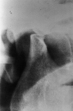 334 Y. H. SHEN et al. Fig. 3. Panorex image of the patient showing right-condyle resorption. Fig. 5.