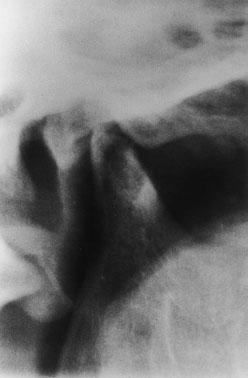 Close-up view of TMJ image showing right-condyle resorption. evidence of any bone-involving systemic diseases such as rheumatoid factors and hyperparathyroidism were found.