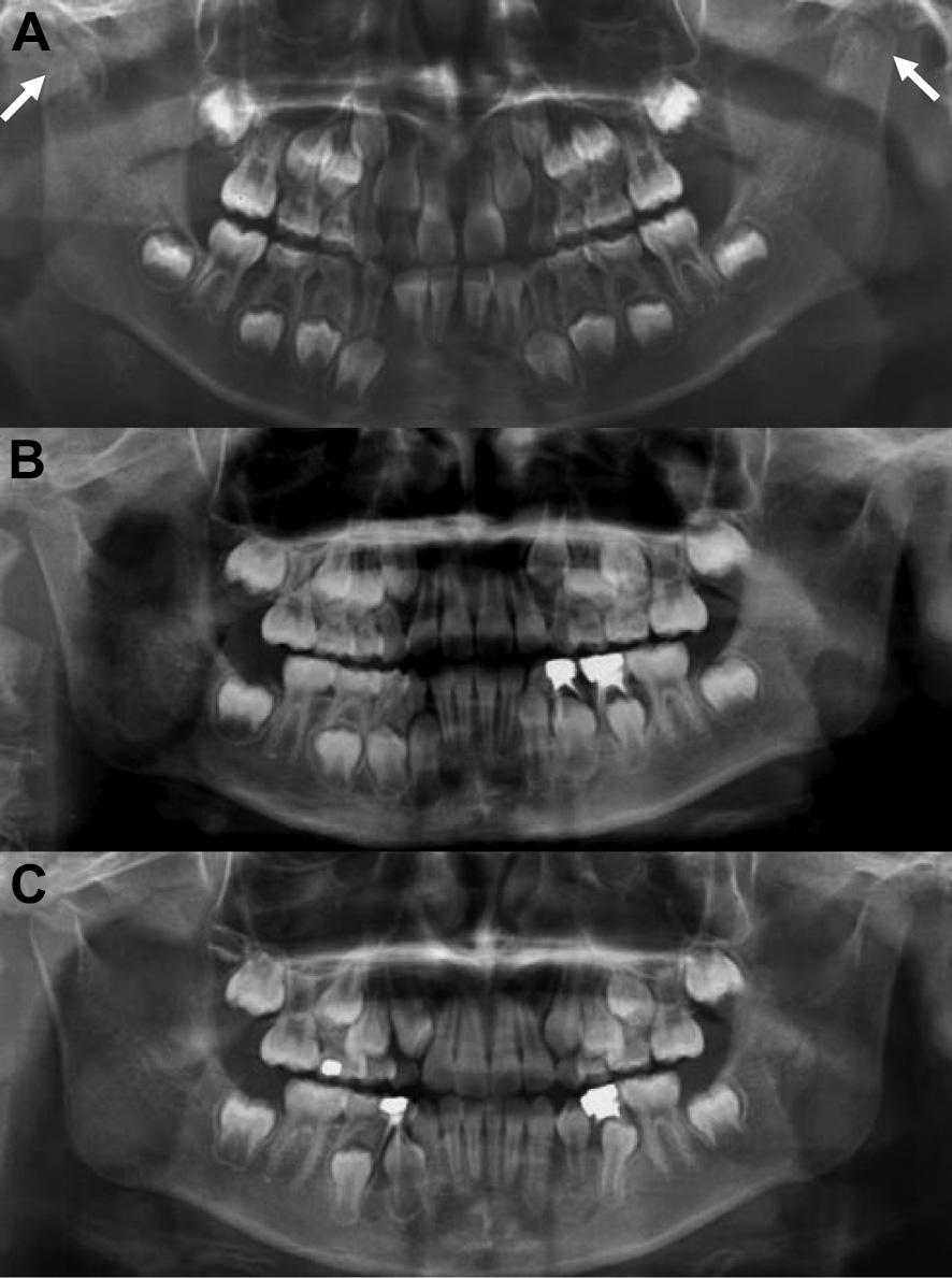 1080 Y.-m. Zhao et al. / Journal of Cranio-Maxillo-Facial Surgery 42 (2014) 1078e1082 a half months after the injury; the other one was a 14-year-old boy (5 mm).