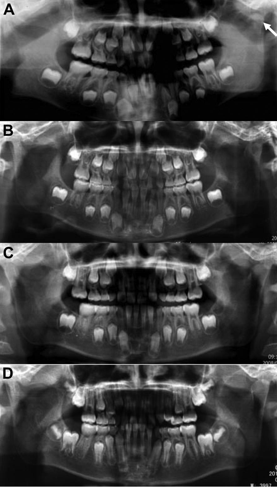 Y.-m. Zhao et al. / Journal of Cranio-Maxillo-Facial Surgery 42 (2014) 1078e1082 1081 slight (<3 mm) deviation to the affected side during mouth opening.