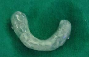 cast is cut at # site and brought into occlusion with maxillary teeth 3.