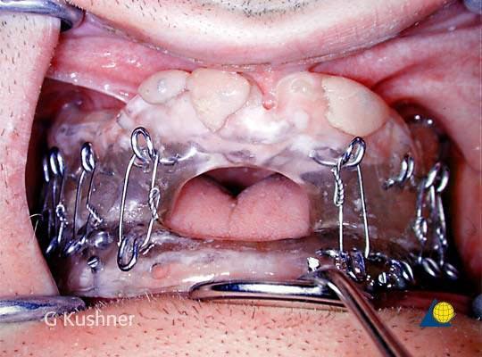 upper and lower base plates with acrylic 5. posterior bite blocks made with hooks on buccal side 6. heat curing done 7.