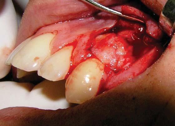 Fig. 1 Gingival recession in tooth #23