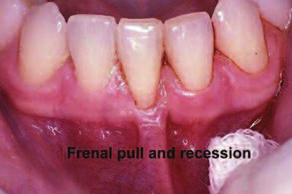 Continued from page 58 How much attached keratinized tissue is enough? In gingival health, 1-2 mm of attached keratinized tissue is adequate 1.
