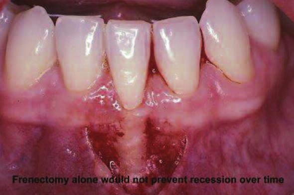 2. Areas that are an esthetic concern to the patient. 3. Areas of progressive recession. Gingival recession should be noted at the initial exam and followed over time.