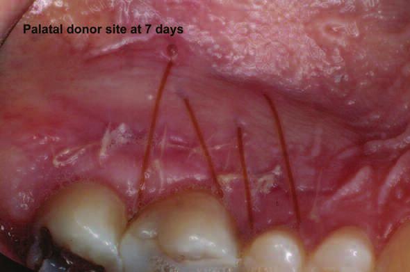 For example, if a patient has a buccal probing of six millimeters, there is a deep periodontal concern.