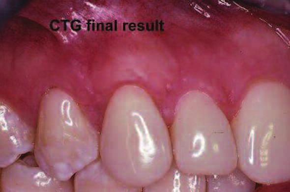 In contrast to using the patient s connective tissue, AlloDerm must be completely covered by an overlying flap or tissue, and it will not result in an increase in keratinized tissue 6.
