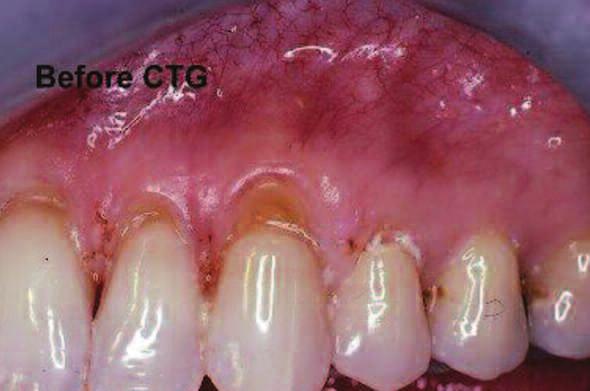 From a practical standpoint, if the tissue in the area of the recession is thin such that the markings of a periodontal probe can be read through it, the use of this material is relatively