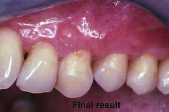 (Figures 12-14) Restorative connection Looking at basic readily visible biologic factors such as tooth position, the amount and thickness of naturally occurring attached keratinized tissue, and