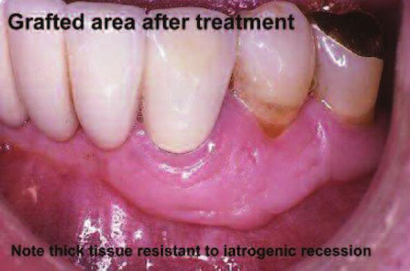 traumatic procedures that occur during restoration such as preparing the restorative margin, impression taking, and cementation. Thin tissue should be corrected prior to restoration.