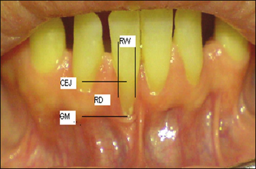 Effects of FGG on dentin desensitization INTRODUCTION Dentin hypersensitivity is defined as the short and transient painful response of exposed dentin, usually cervical, to thermal, tactile, osmotic,