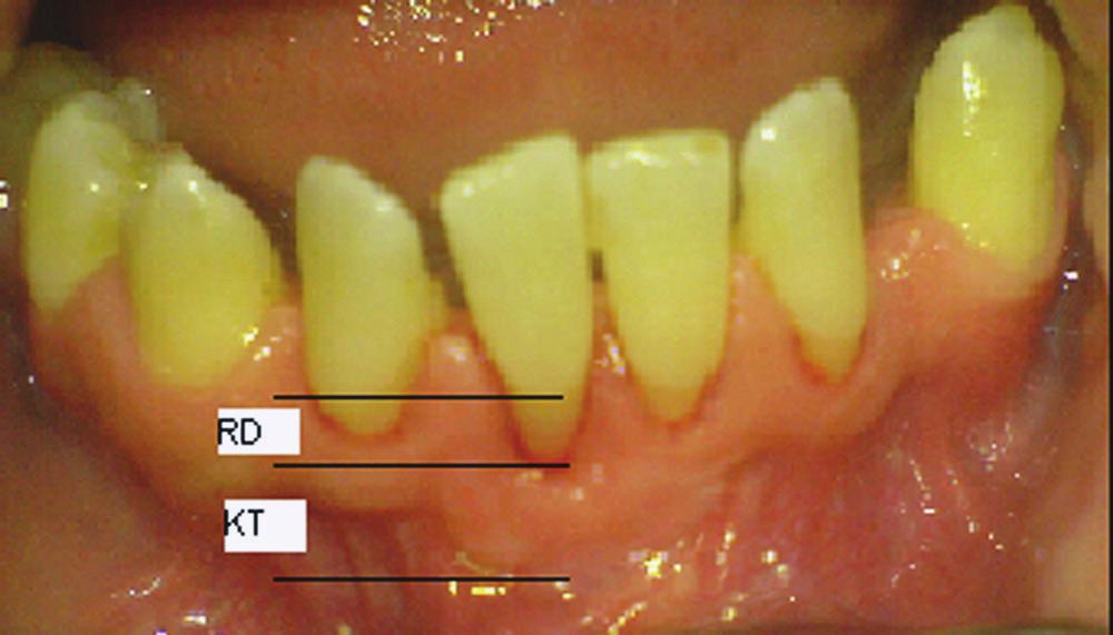 mucosa. A partial thickness flap of epithelial and connective tissue was raised, and the recipient site was prepared 3 mm apical to the most apical part of the exposed root.