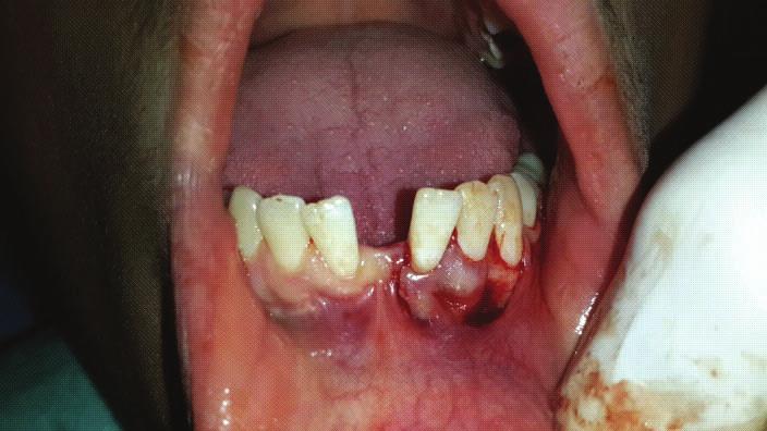 gingival sulcus. Clinical attachment level () - measured from the cemento enamel junction to the bottom of the pocket. Clinical photograph was taken before and after the operation.