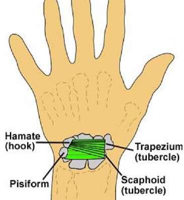 DUPUYTRENS CONTRACTURE OF PALMAR APONEUROSIS - sometimes, the palmar aponeurosis can cause contracture called Dupuytrens contraction o there is thickening and shrinking of the palmar aponeurosis o