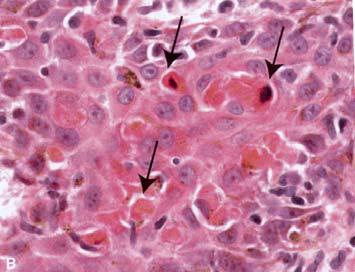 hepatitis Skin in erythema multiforme Morphology of apoptosis