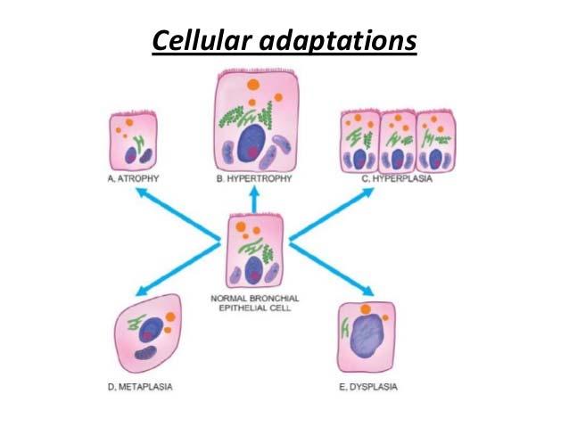Cellular adaptive changes Atrophy - reduction in cell size Involution/ Hypoplasi -