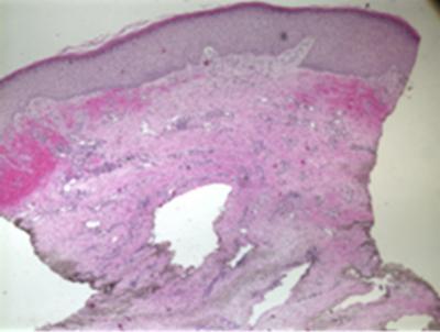 inflammatory infiltrate and thickened collagen bundles (Figure 2, 3, 4).