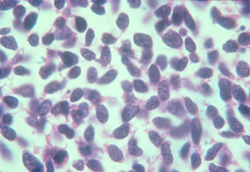 Small Cell ( oat cell ; L-MYC): Distinguishing Characteristics Pathology Warning: SCC is a NeuroENDOCRINE SIADH and Ectopic ACTH are endocrinopathies.