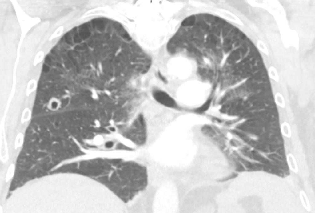 Classic Presentations: Smoker with cavitary lesion and calcium of 11.8 mg/dl.