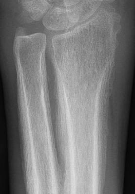 Hypertrophic Osteoarthropathy 1. Characterized by periosteal reaction of long bones of distal extremities. 2.