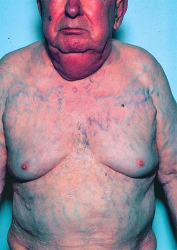 SVC Syndrome Bronchogenic most common cause (lymphoma