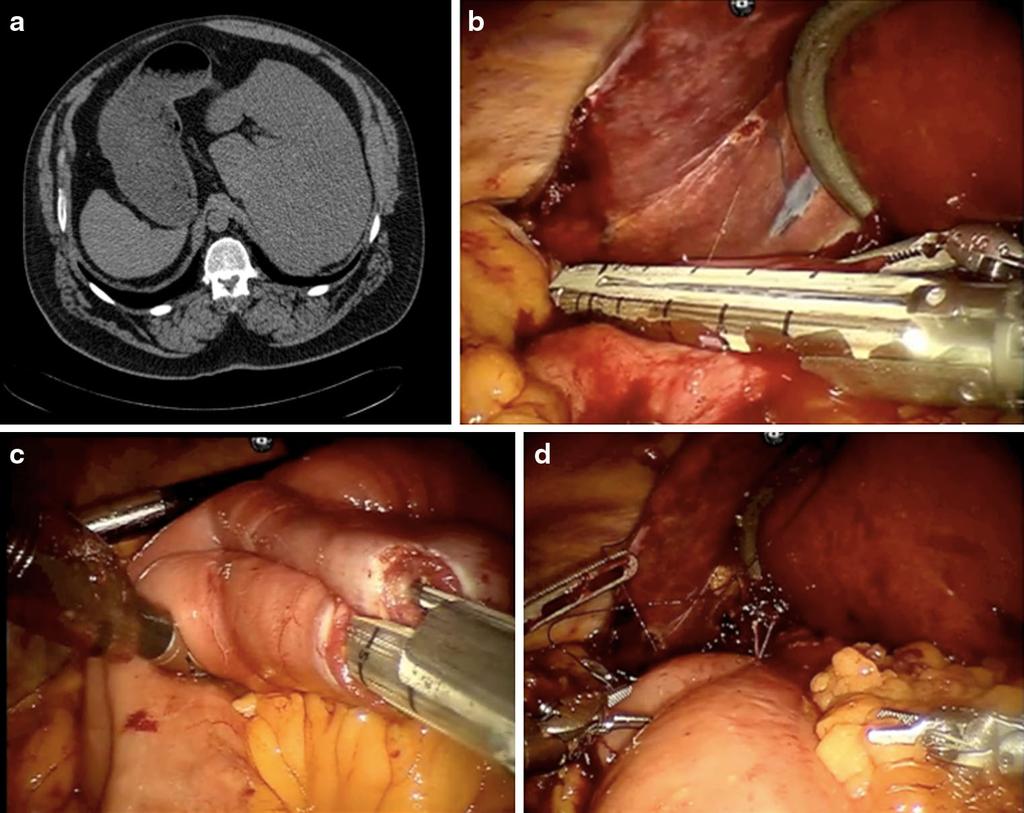 J Robotic Surg (2014) 8:169 171 171 Fig. 2 Preoperative and intraoperative imaging. a Preoperative CT scan demonstrating situs inversus. b Gastric pouch creation. c Enteroenterostomy.